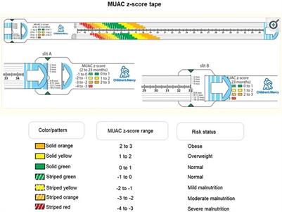 The significance of MUAC z-scores in diagnosing pediatric malnutrition: A scoping review with special emphasis on neurologically disabled children